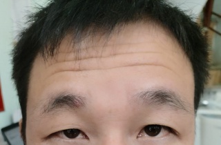VÌ SAO CÓ NẾP NHĂN TRÁN